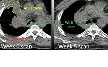 Image from Nate Tennyson's paper showing differences in tumor position at baseline and the fifth week of radiation therapy due to atelectasis changes.