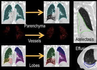 Left: registration process includes mass-preserving registration of the lung parenchyma, segmentation and registration of the lung lobes, and segmentation and registration of the pulmonary vessels.