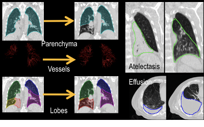 Left: registration process includes mass-preserving registration of the lung parenchyma, segmentation and registration of the lung lobes, and segmentation and registration of the pulmonary vessels.