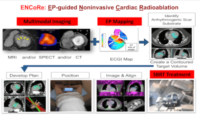 Steps in the workflow for noninvasive cardiac radioablation.